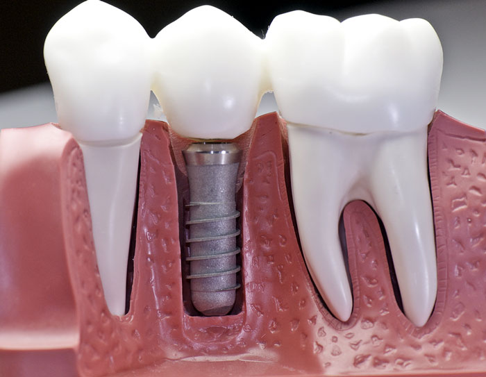Etobicoke Dentist - West Metro Dental - Dental Implants