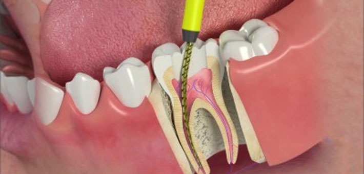 Metro Dental Etobicoke Proud To Have In House Endodontist