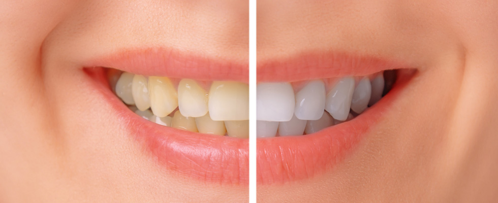 Why Patients Prefer Zoom Whitening Treatments