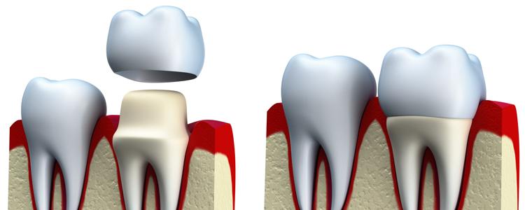 Etobicoke Dentist - West Metro Dental - Dental Crown