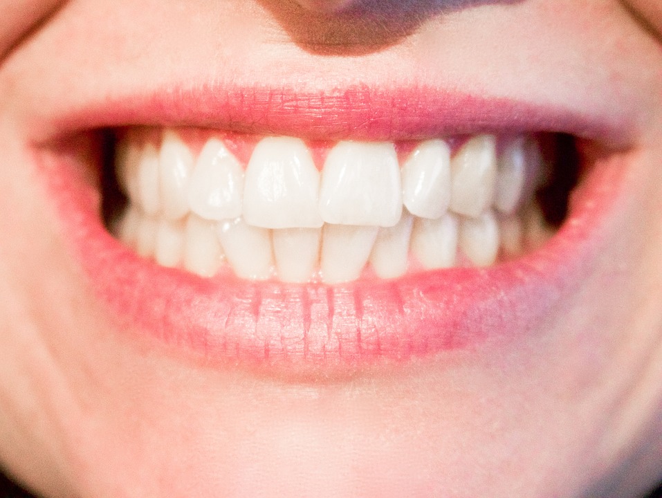 Etobicoke’s Metro Dental Shares A Few Facts About Dental Veneers